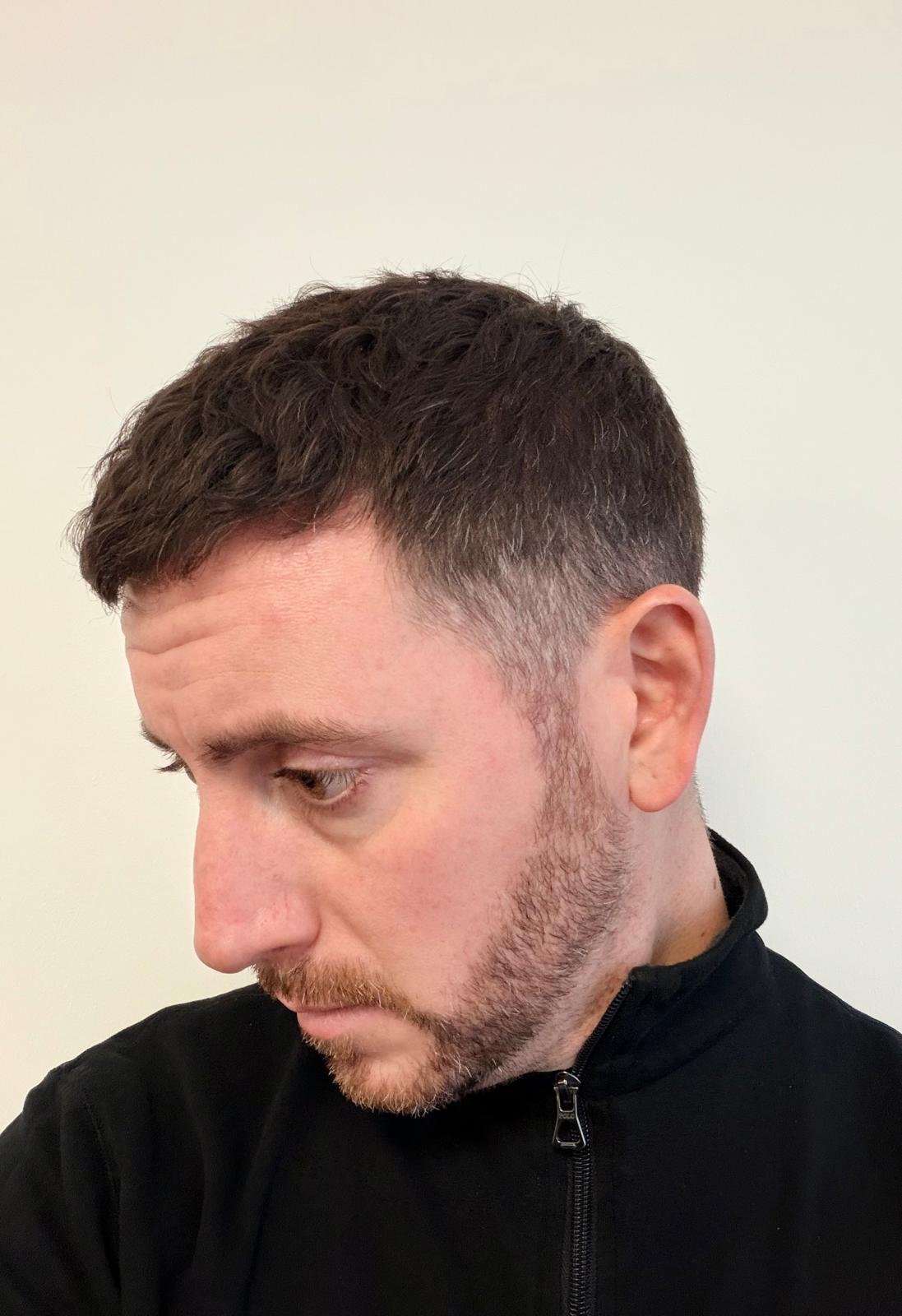 Prima e Dopo Trapianto Barba e Capelli 5100 Grafts - Paziente 1 Dopo 9 Mesi