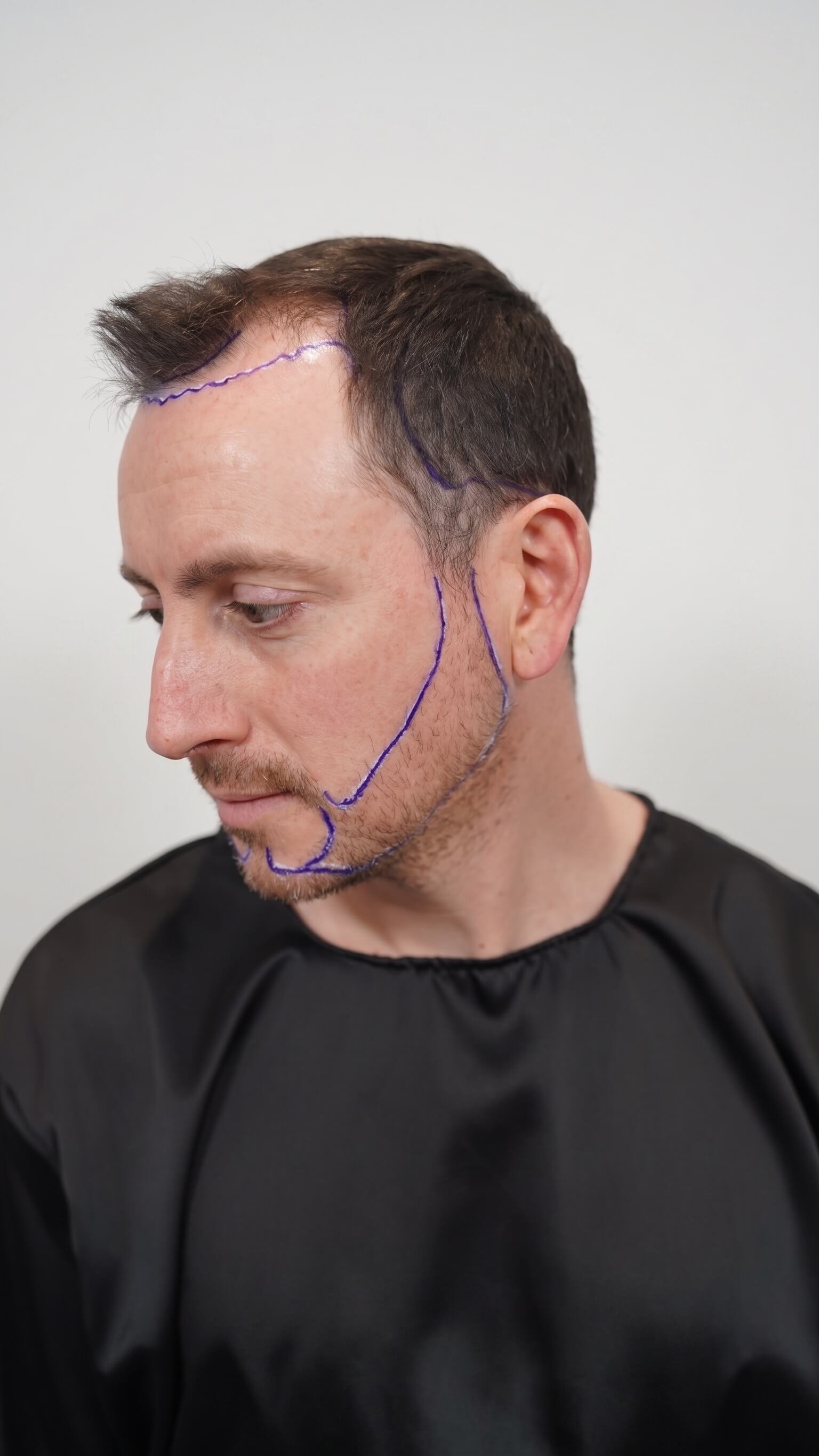 Prima e Dopo Trapianto Barba e Capelli 5100 Grafts - Paziente 1 Prima