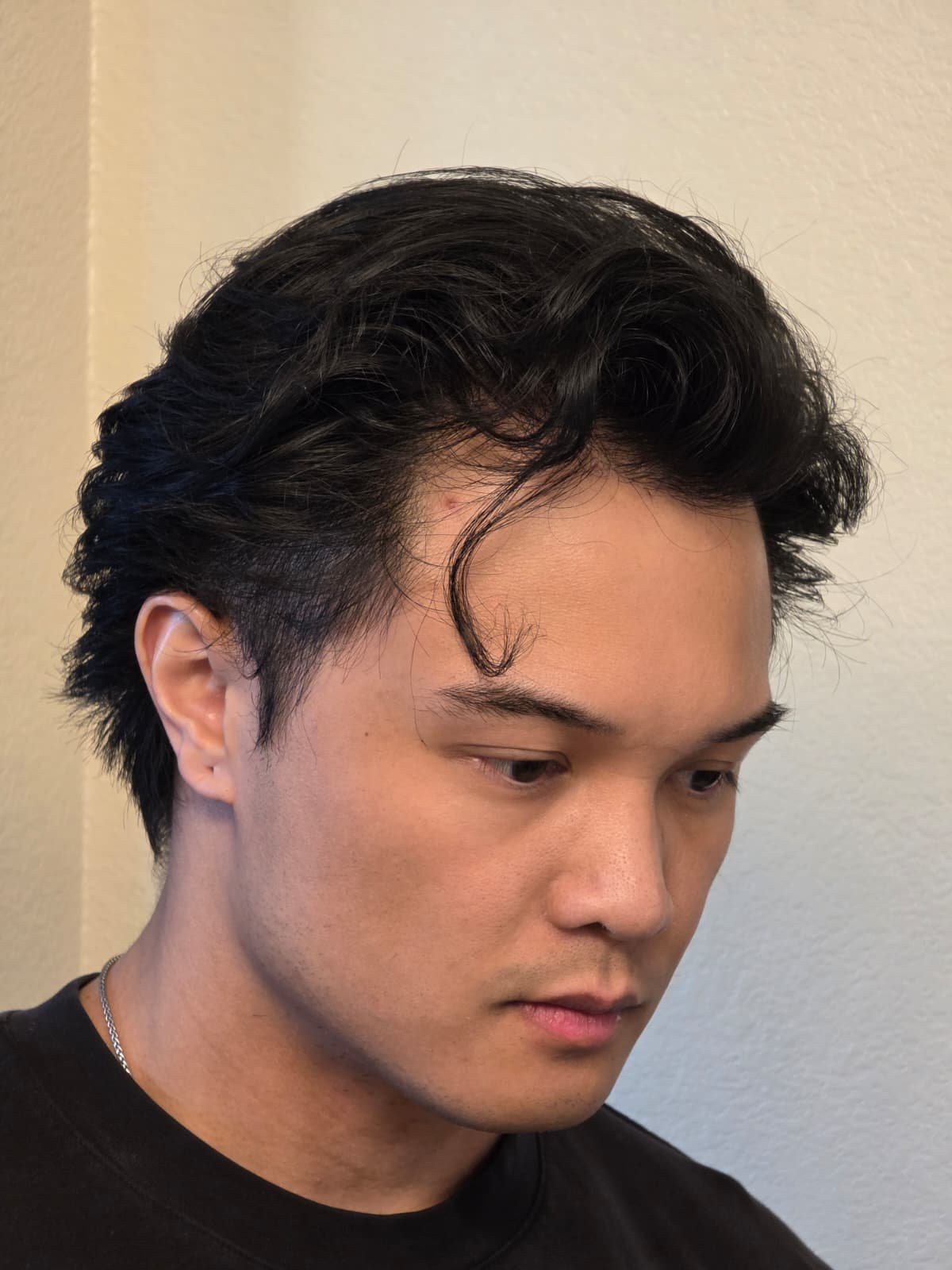 Prima e Dopo Trapianto Capelli FUE + DHI 3550 Grafts - Paziente 2 Dopo 12 Mesi