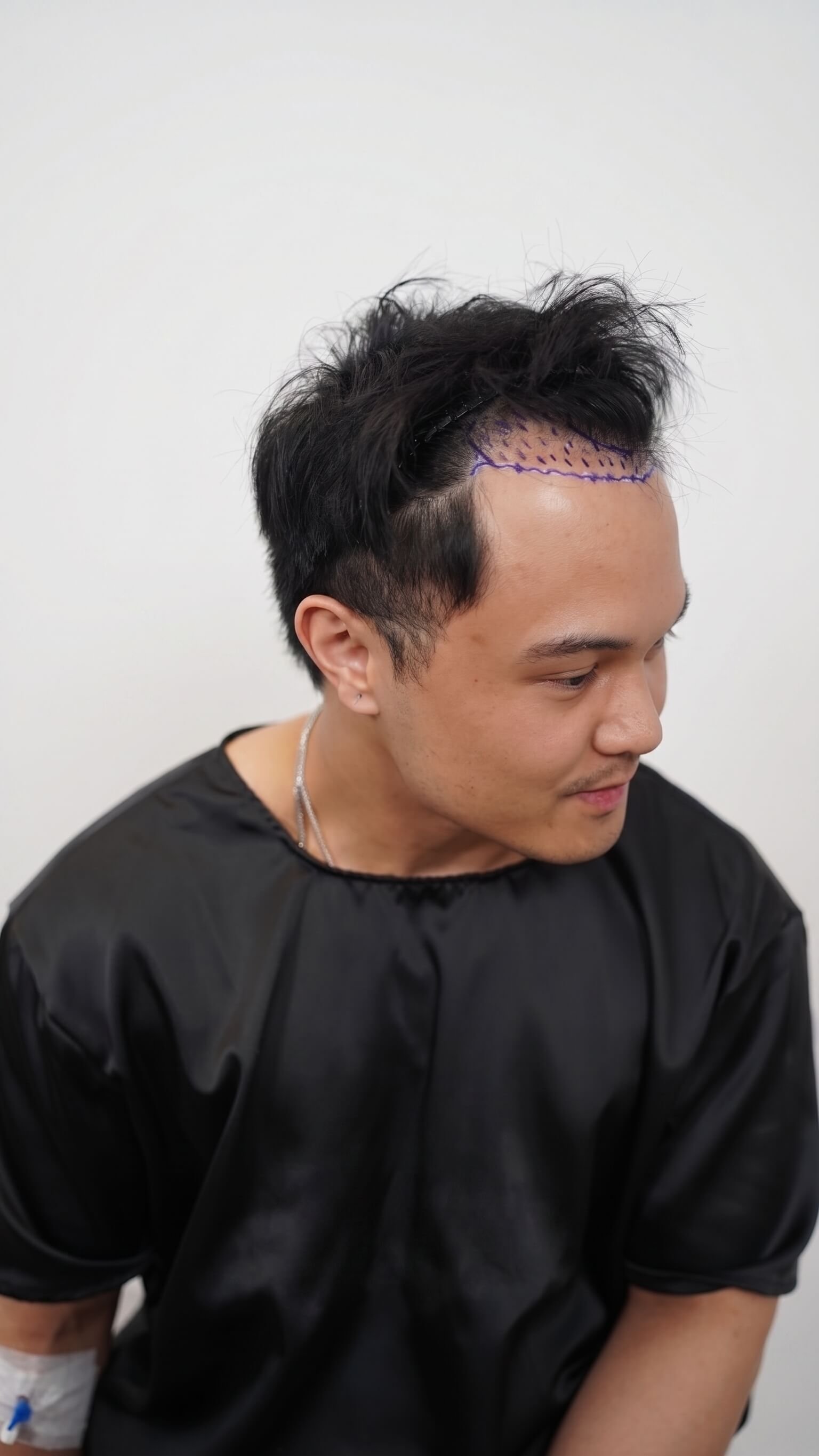 Prima e Dopo Trapianto Capelli FUE + DHI 3550 Grafts - Paziente 2 Prima